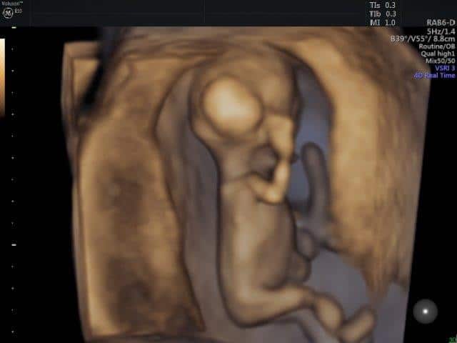 12 Week Ultrasound: What to Expect at 12 Weeks of Pregnancy?