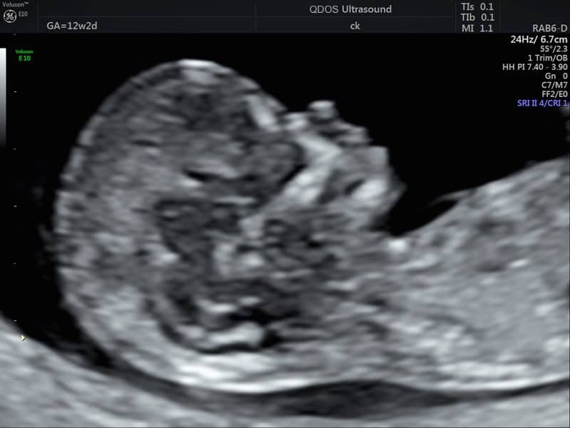 12 week 2d scan