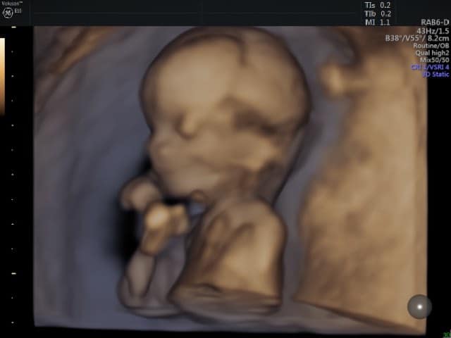 ultrasound scan 12 weeks pregnant