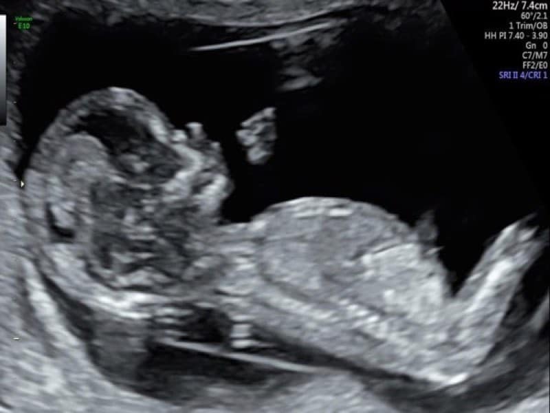 12 weeks ultrasound